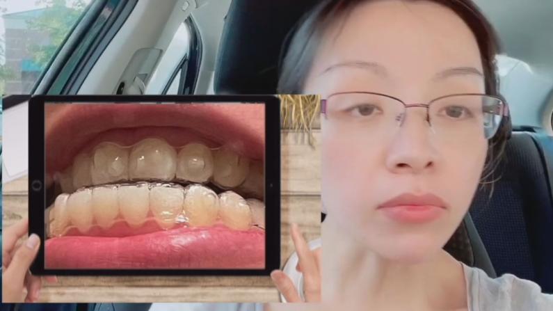 【北卡徐阿姨】隐适美全记录：人到中年矫正牙齿值不值？
